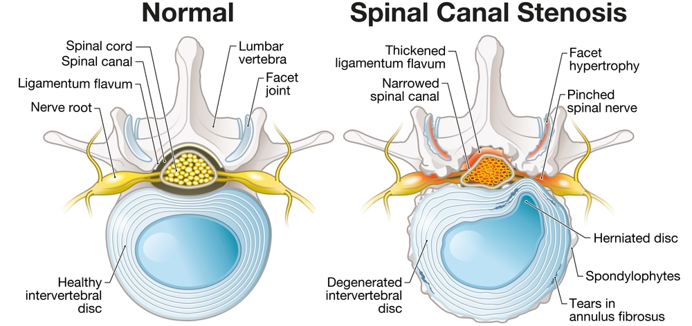 spinal stenose